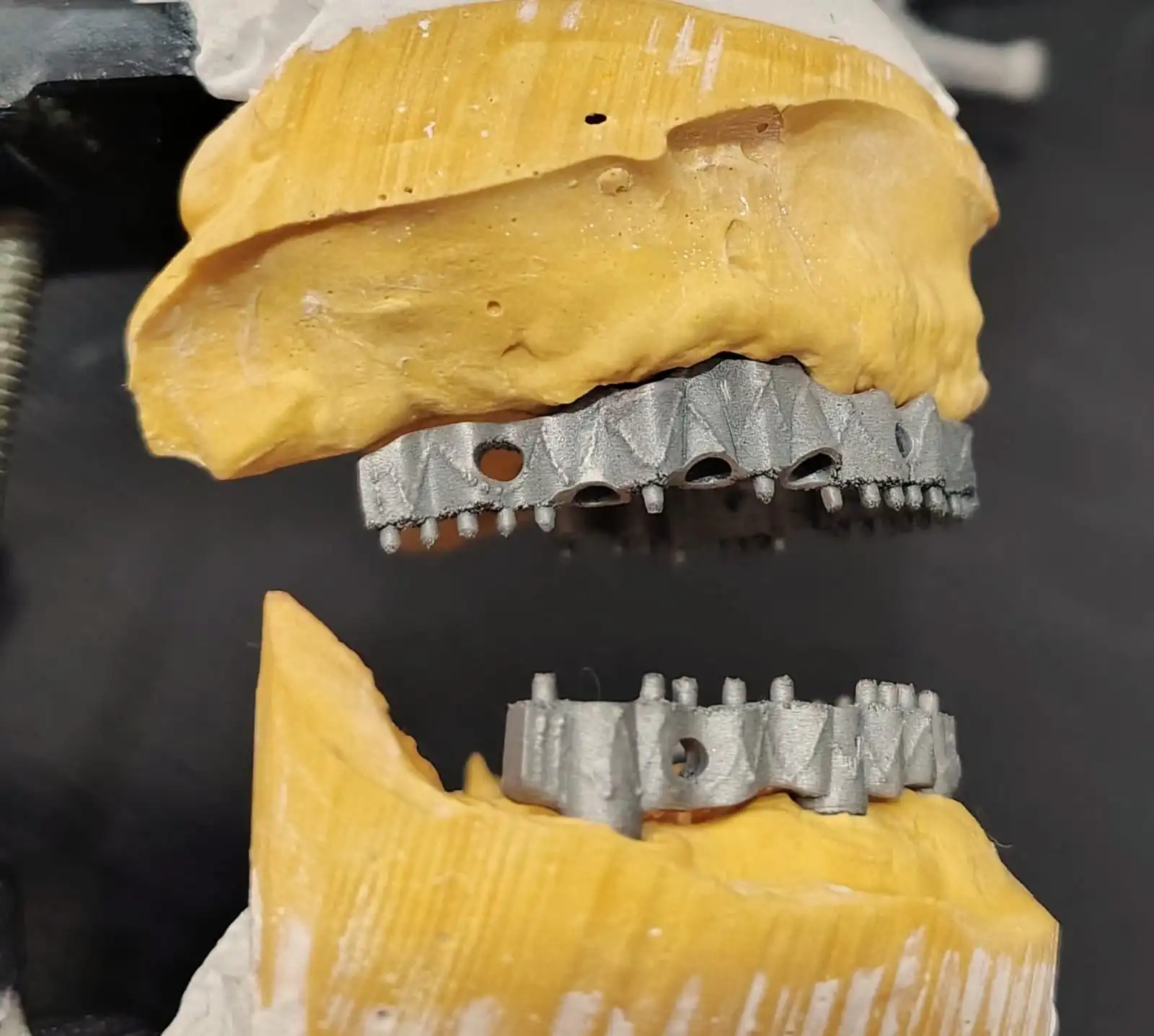 Estructuras sobre implantes dentales