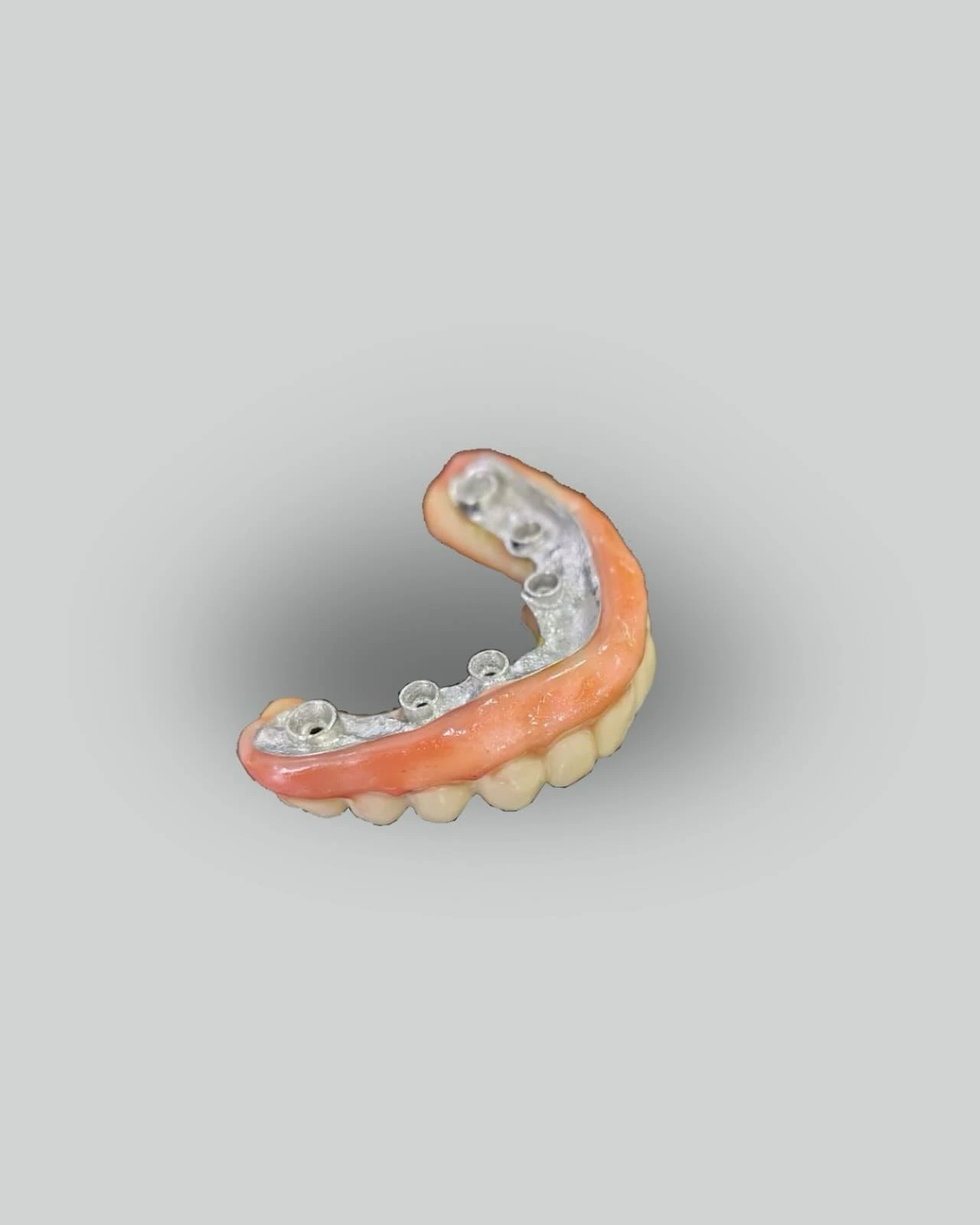 Detalle de prótesis híbrida sobre implantes con montaje de dientes y acrílico rosado