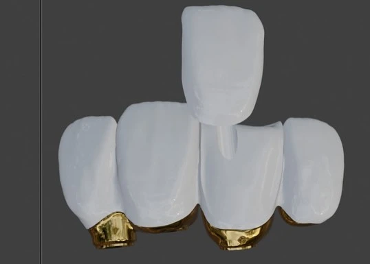 Corona cerámica sobre metal con terminación de porcelana feldespática