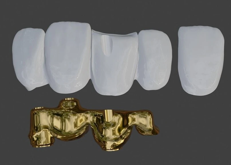 Puente cerámica sobre metal con estructura de cromo cobalto y porcelana aplicada