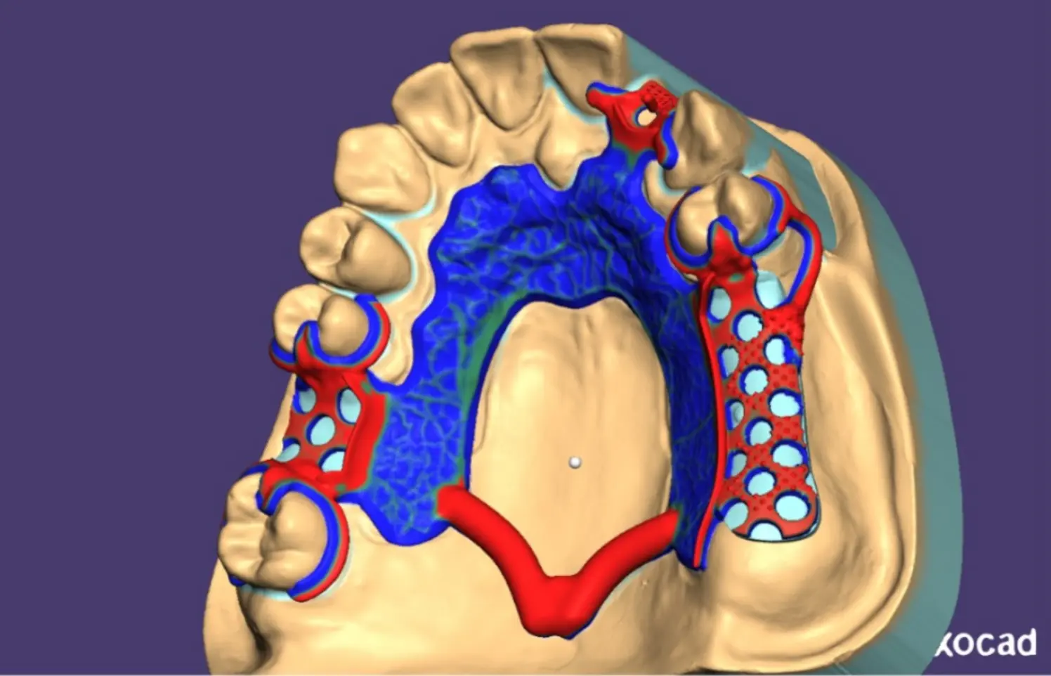 Diseño CAD dental en Exocad PartialCAD