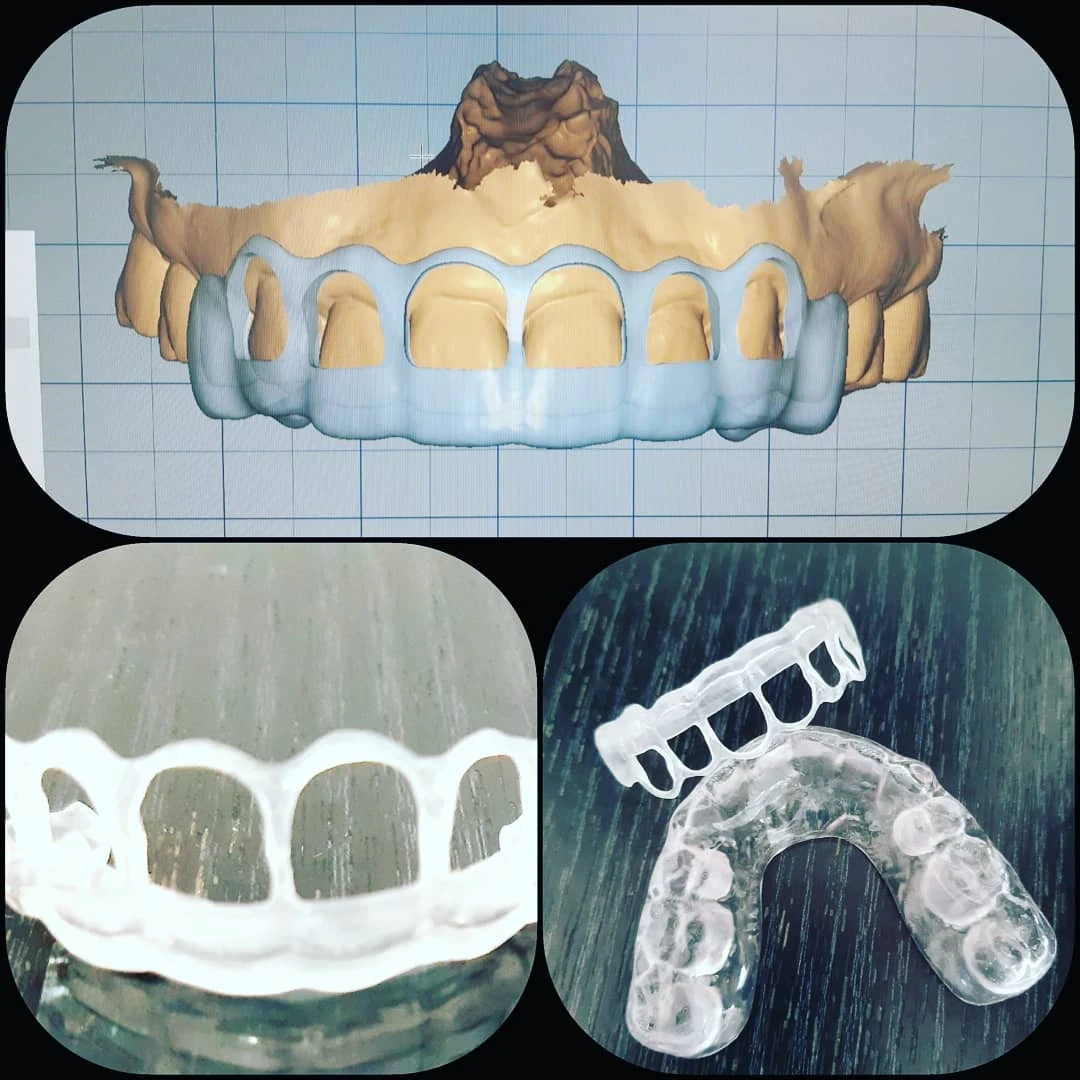 Guía 3D para gingivoplastia