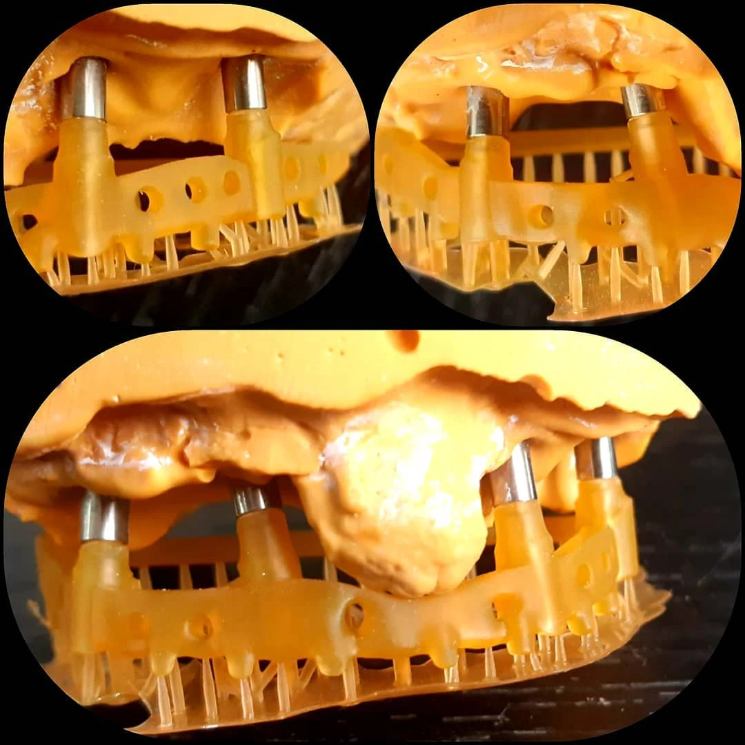 Guía quirúrgica para implantes impresa en 3D