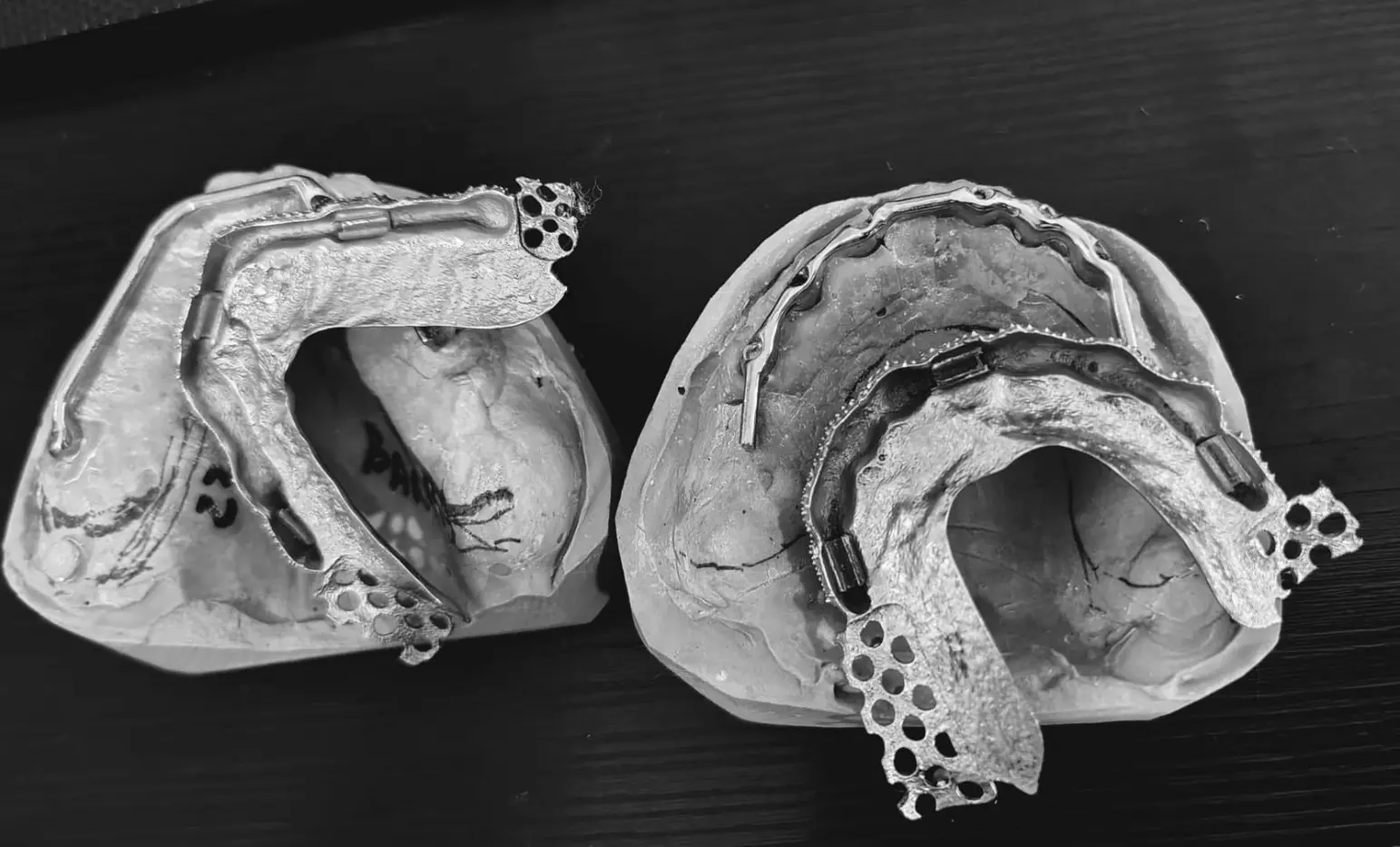 Estructuras sobre implantes dentales