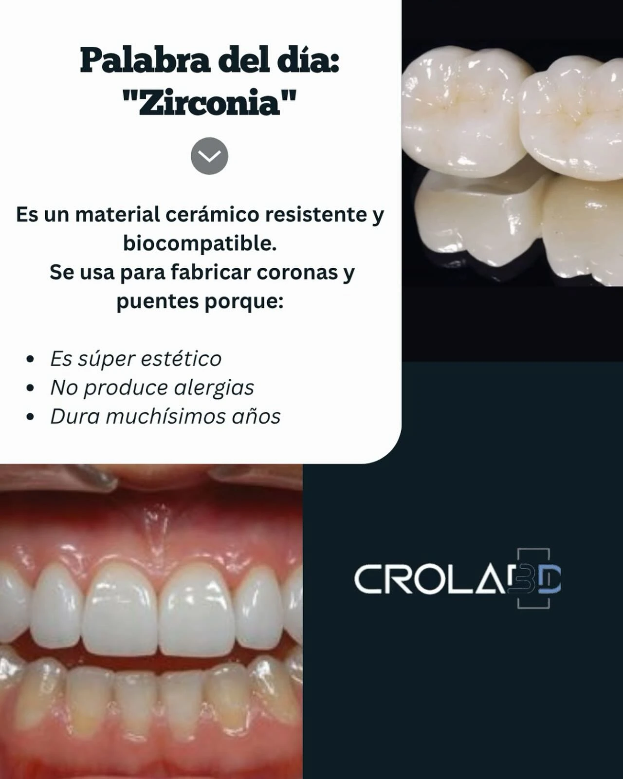 Coronas de zirconio dental monolítico terminadas con alta estética