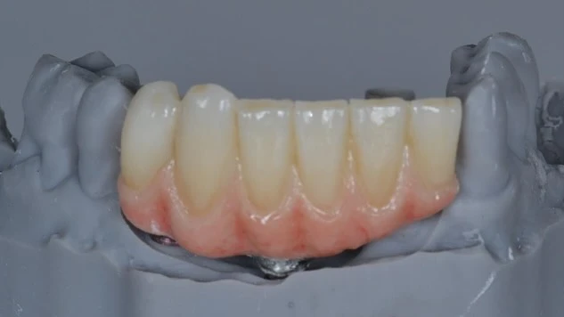 Coronas en zirconio dental terminadas